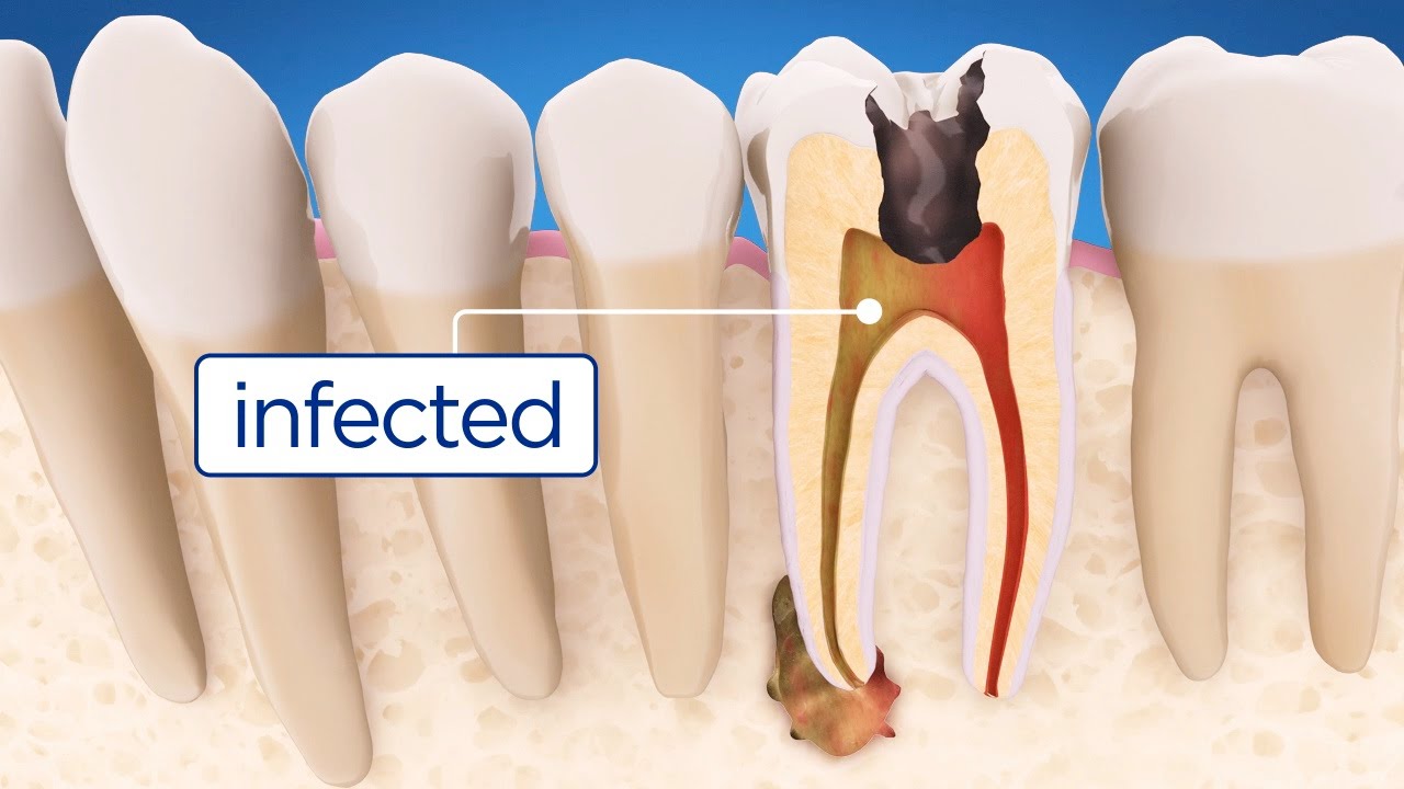 Root Canal 
